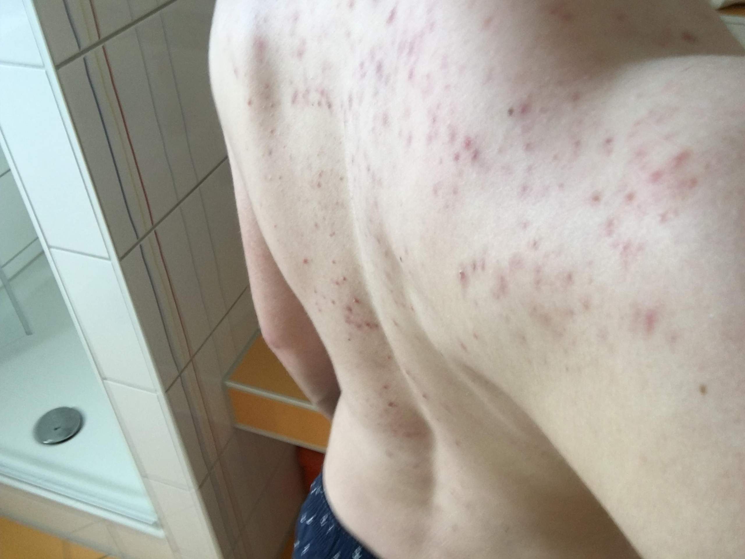 Pickel ??? beulen am rücken, 10 Mögliche Gründe für Beulen auf Ihrer Haut