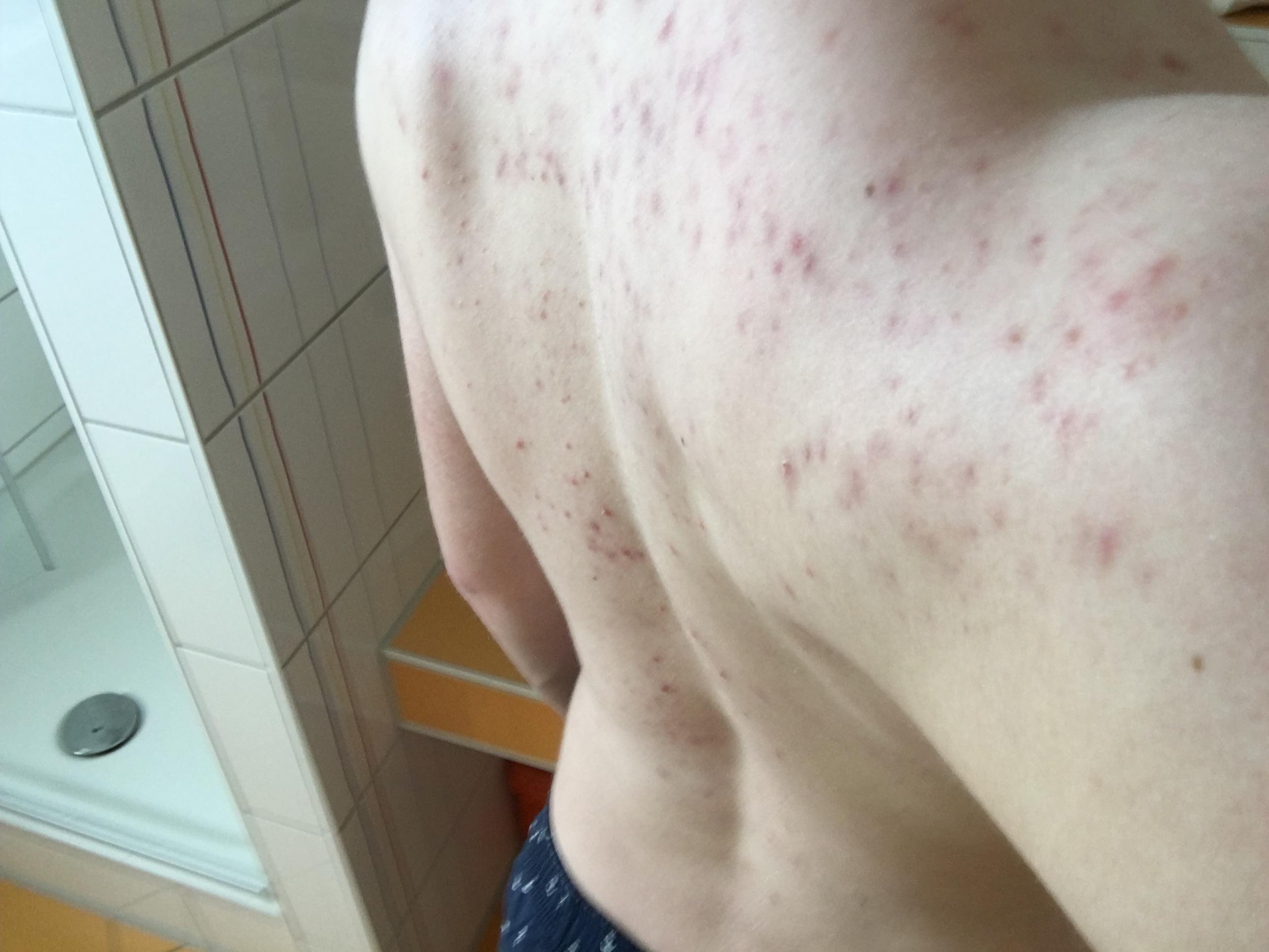 Pickelmale Rücken Ingwersaft gegen Pickelmale und Pickelnarben Wer
