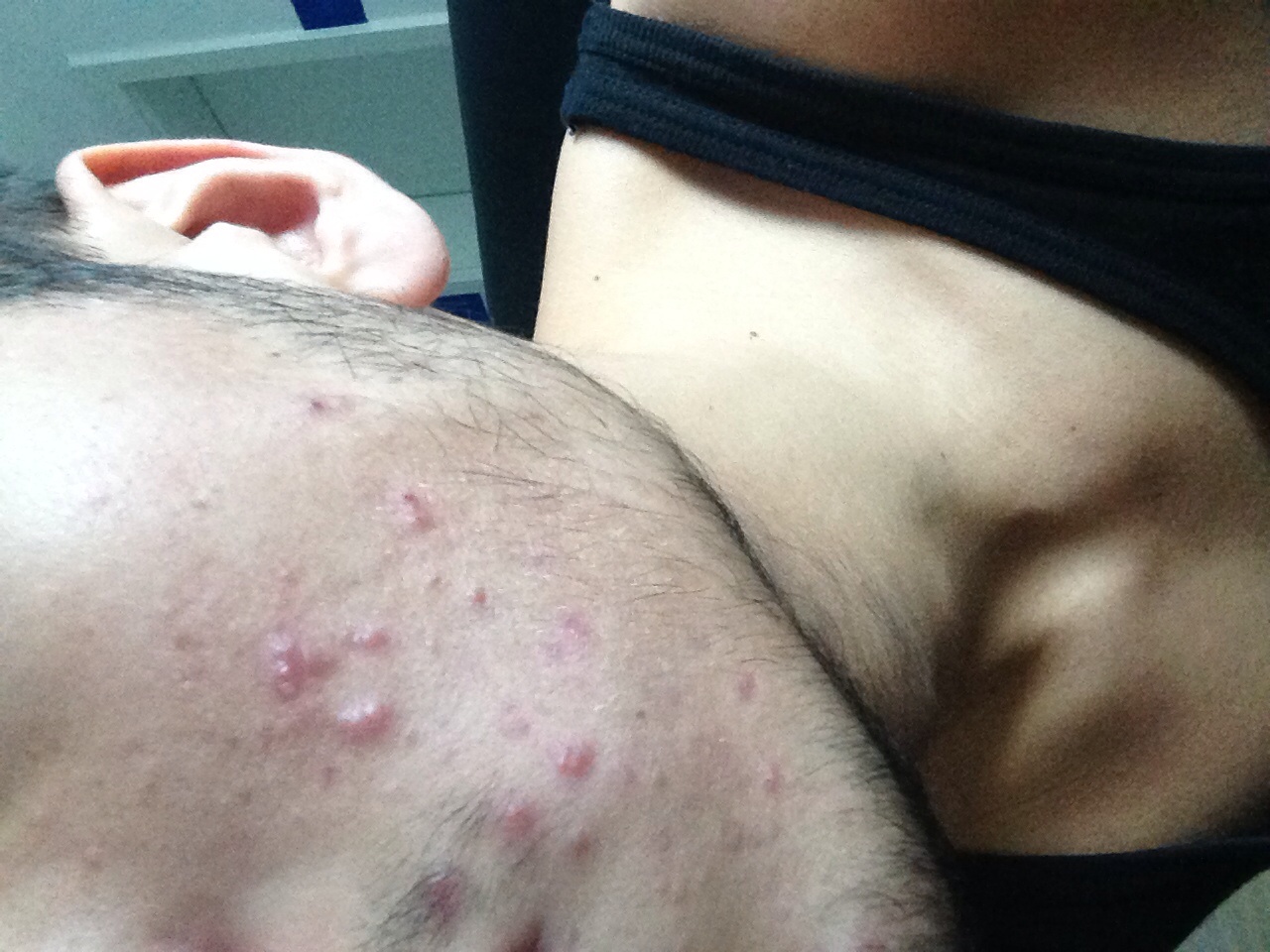 pickel auf backe pickel auf backe