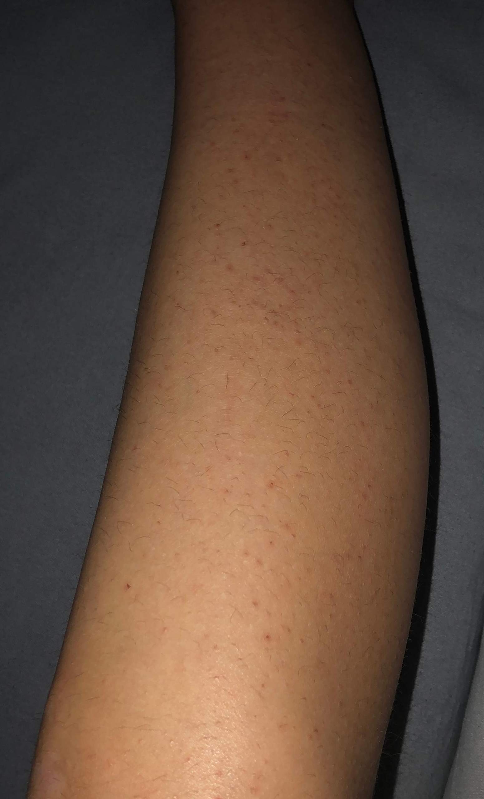 Pickel an den Beinen? (Haut)