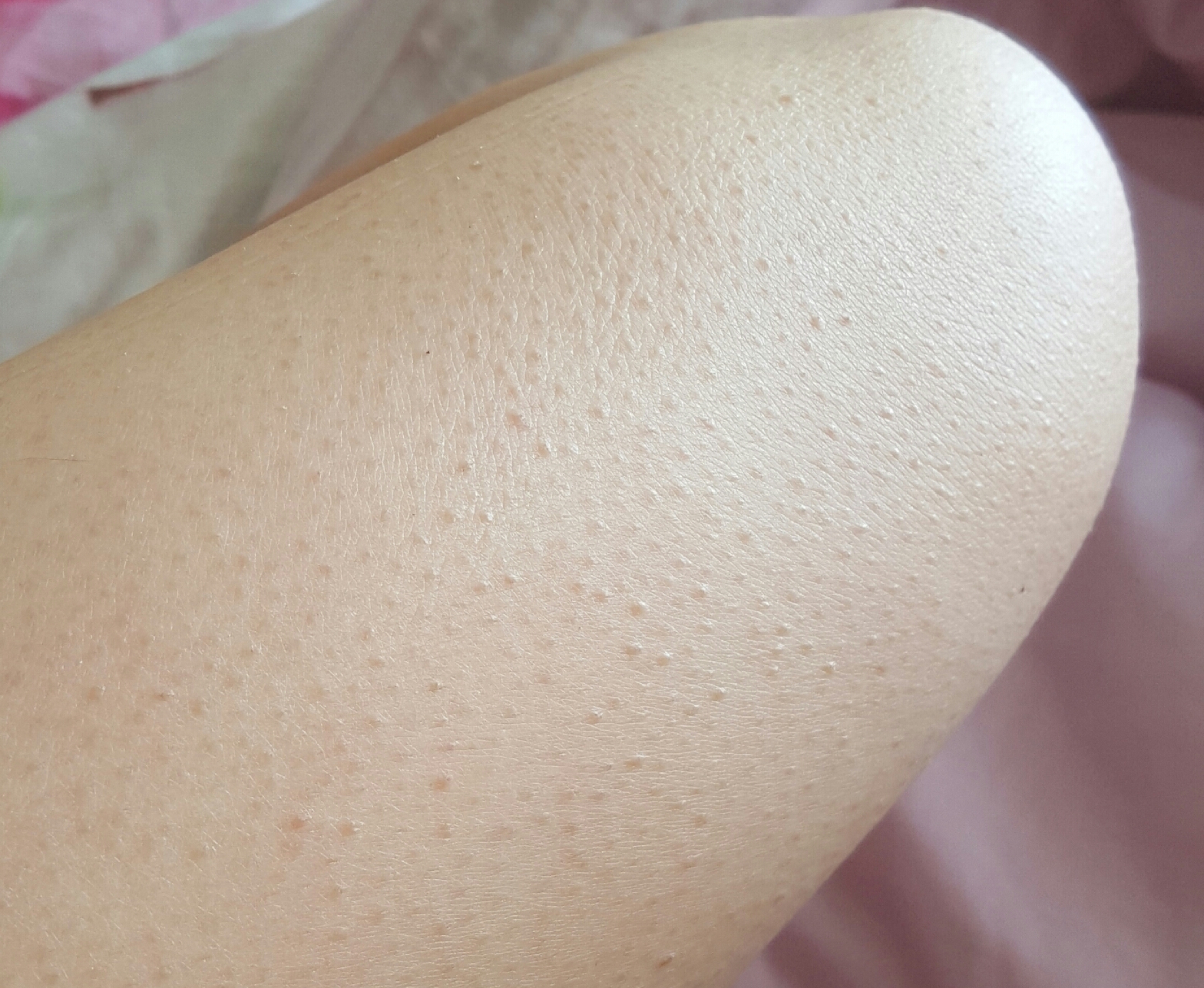 Pickel an den Beinen ?Was tun ? (Haut) pickel auf beinen