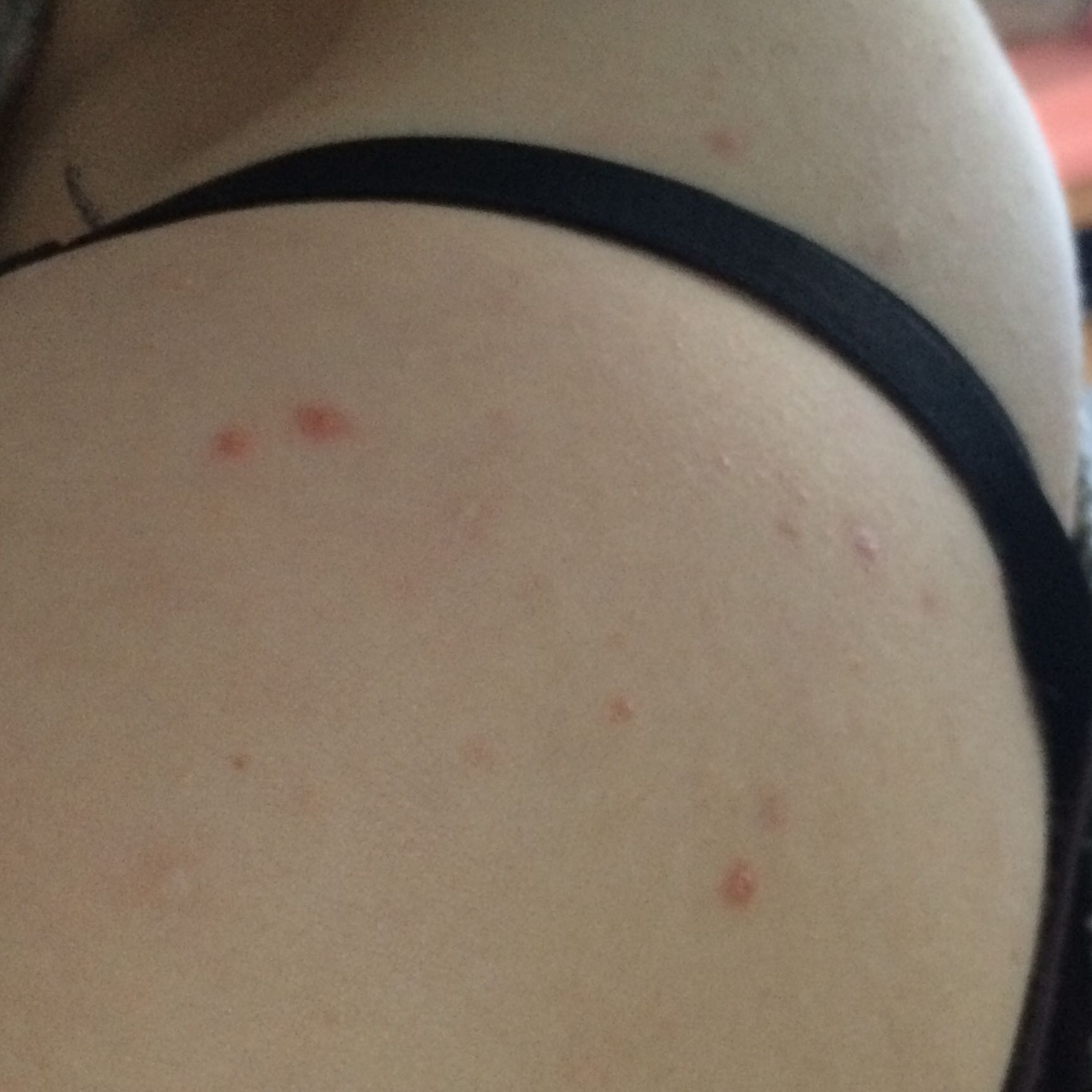 Pickel an den Schultern (Mädchen, Pubertät, Akne) pickel auf der schulter