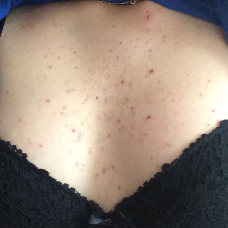 Pickel an der Brust (Pubertät, Brüste) Pickel an der Brust (Pubertät, Brüste)