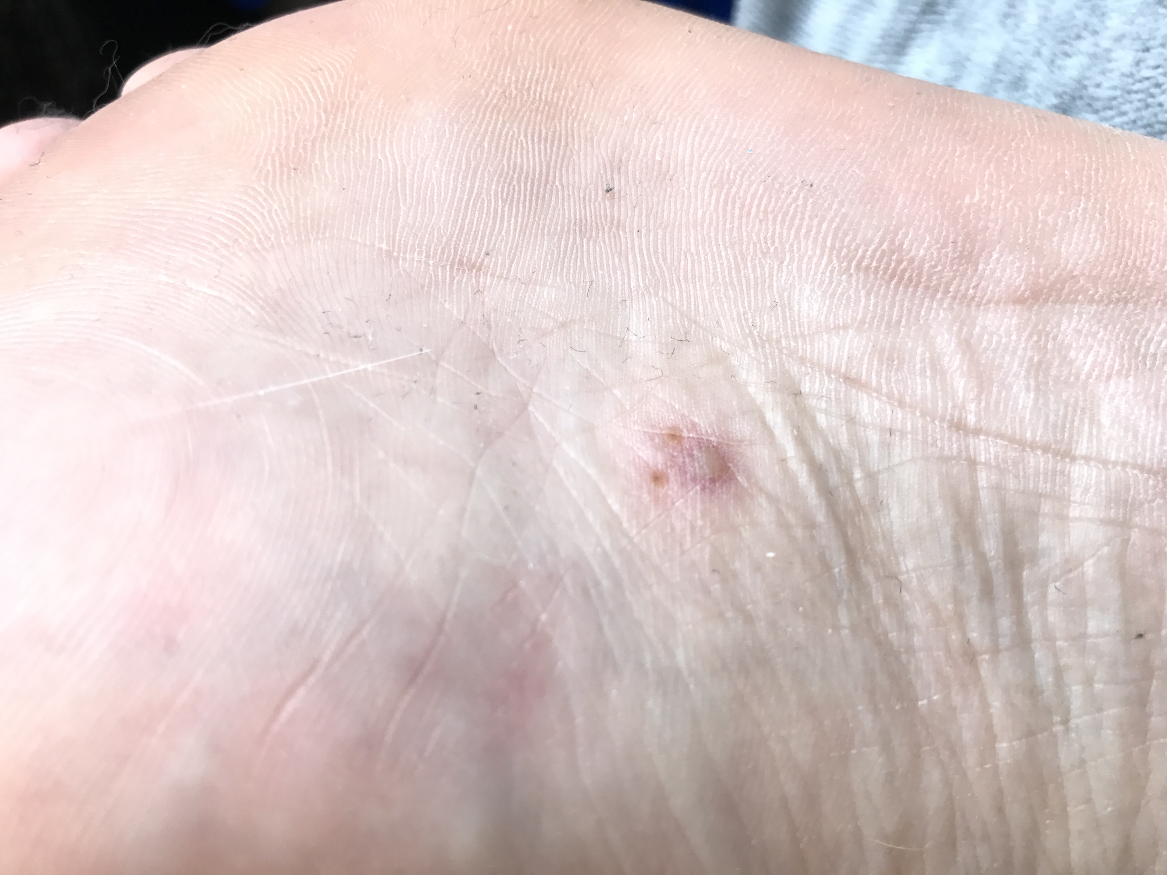 Pickel an der fußsohle? Oder warze? (Füße, Warzen, fußpilz)