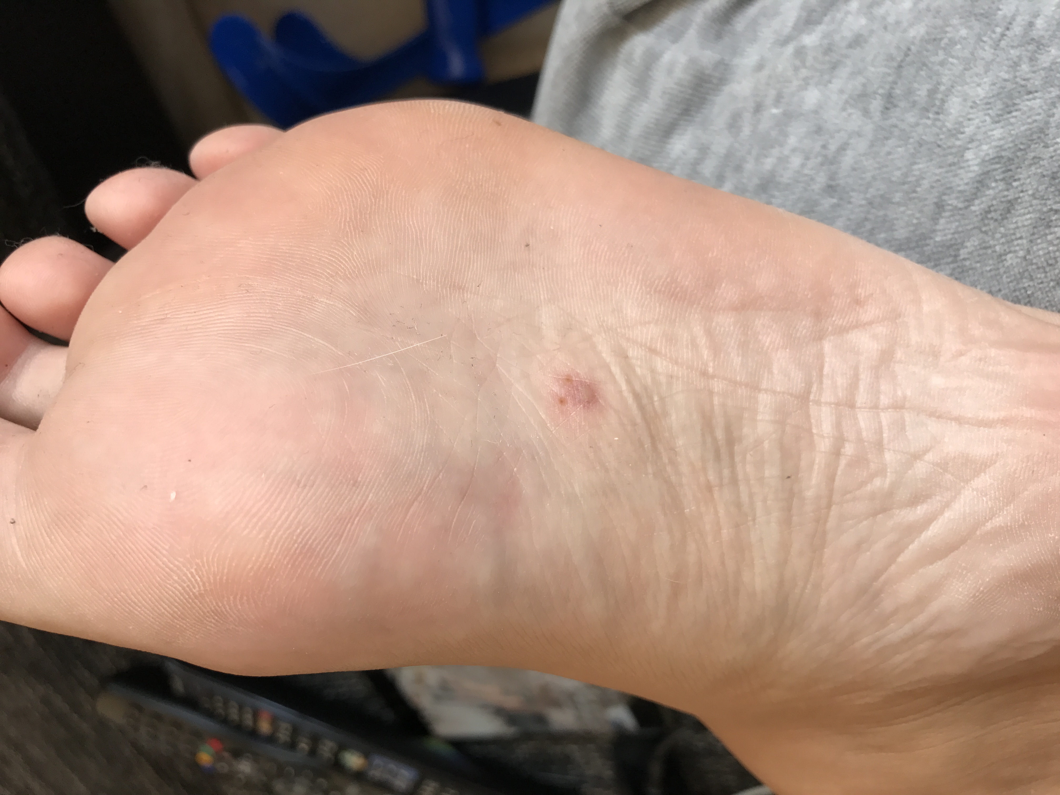 Pickel an der fußsohle? Oder warze? (Füße, Warzen, fußpilz)