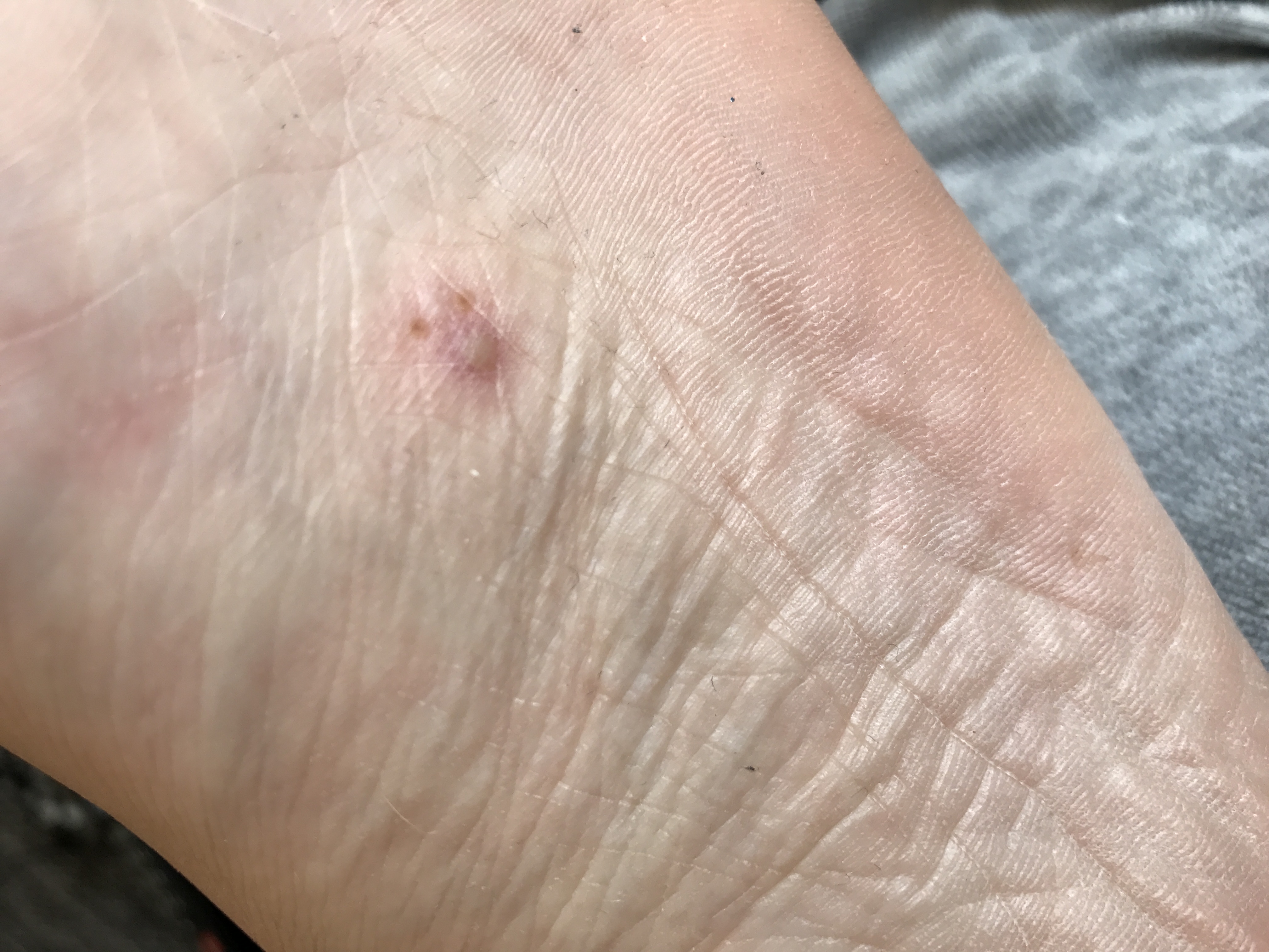 Pickel an der fu?sohle? Oder warze? (Fü?e, Warzen, fu?pilz) pickel auf dem po