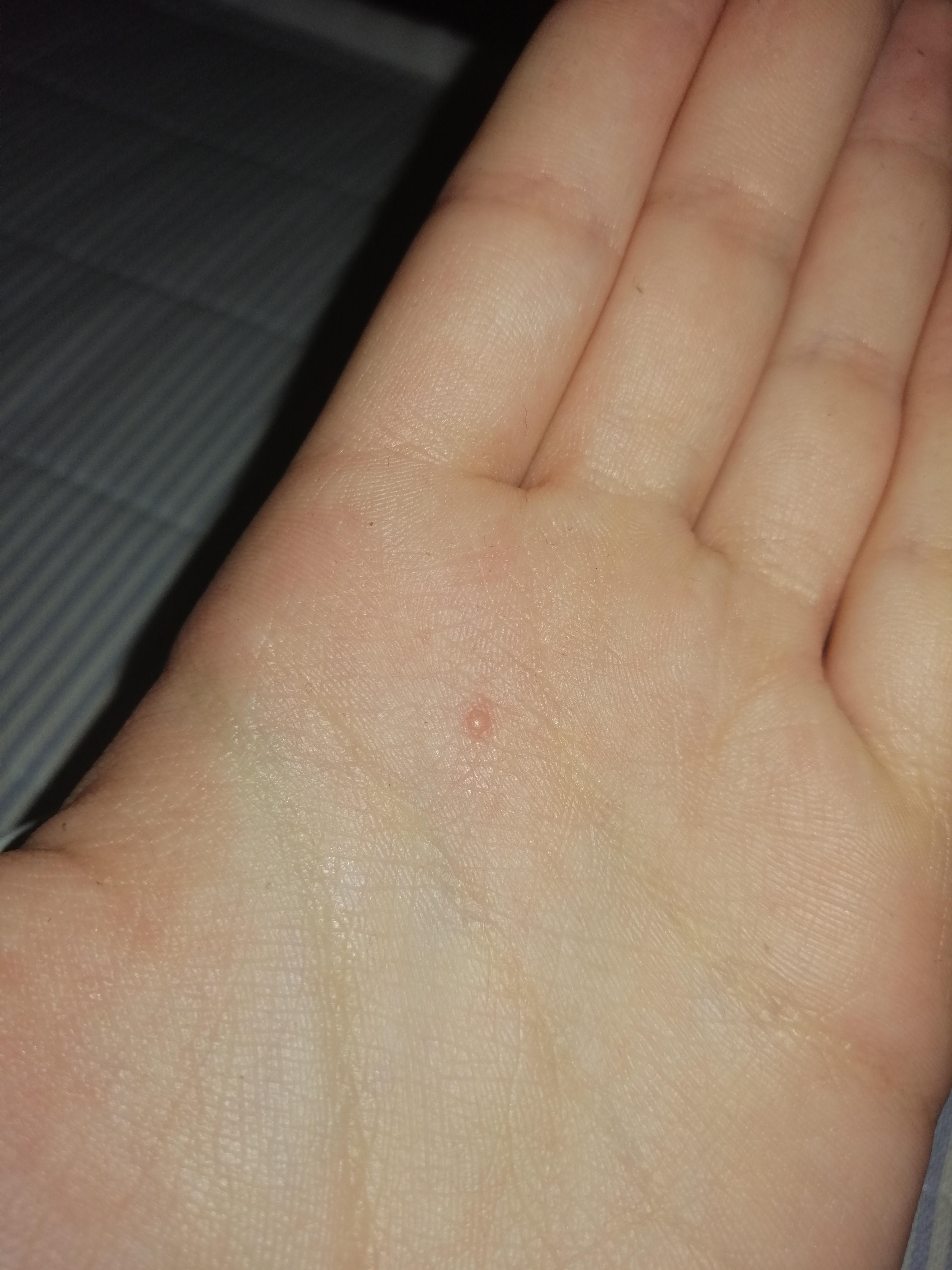 Pickel an der Hand oder was anderes? (Krankheit, Warzen) pickel hand