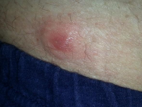 pickel am hintern pickel am hintern