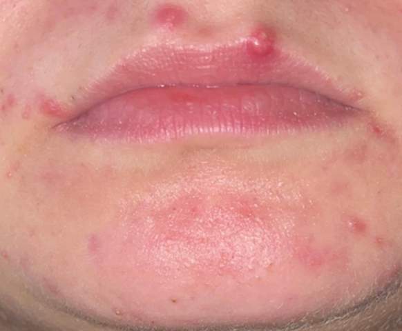Pickel an der Lippe was kann ich machen? (Gesundheit und Medizin, Herpes)