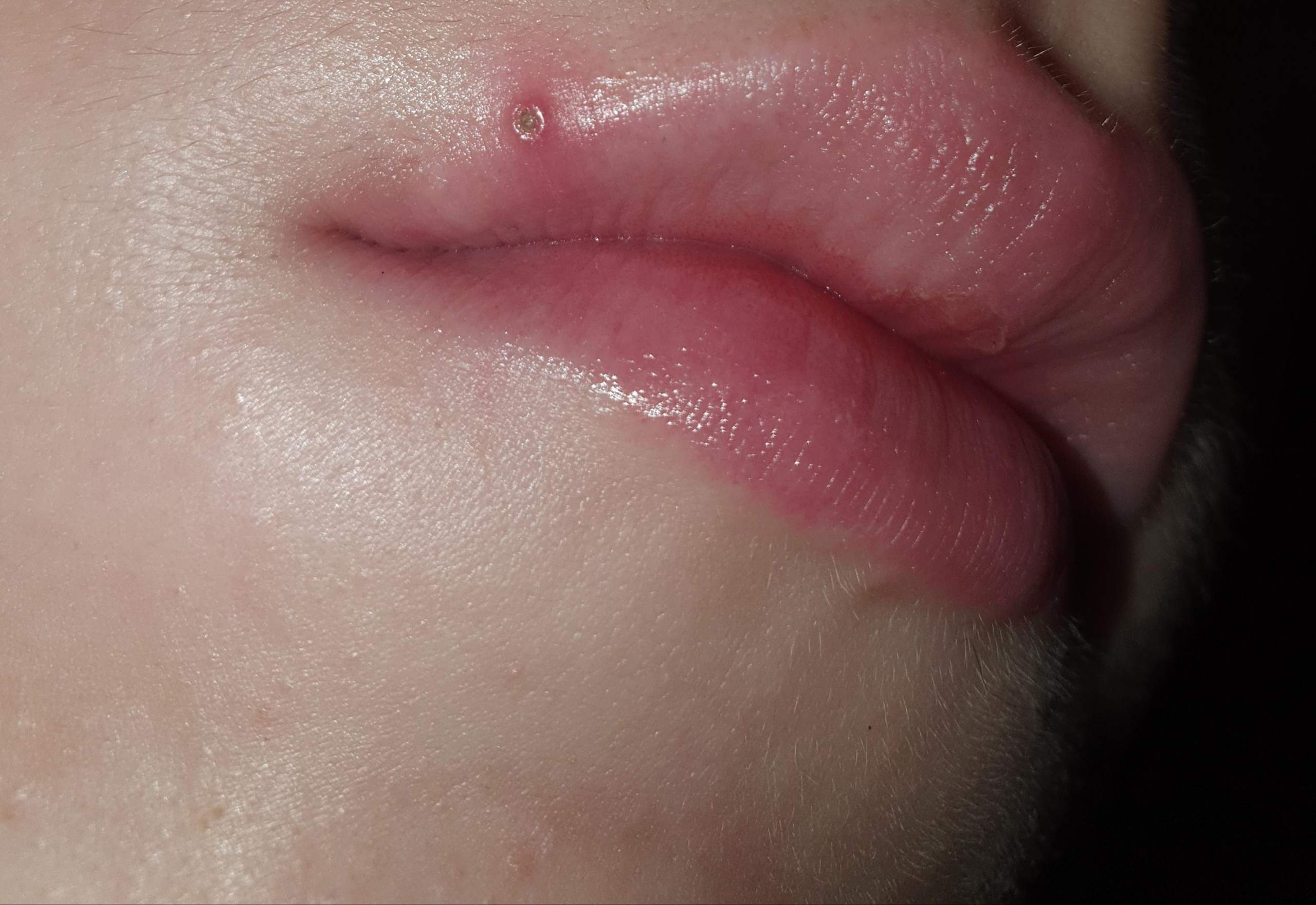 Pickel an der Lippe, was tun (tut weh)? (Gesundheit und Medizin