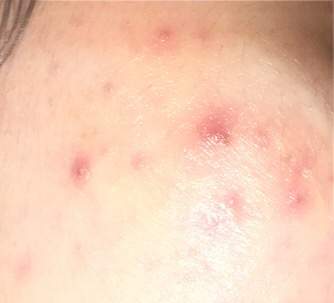 Pickel an der Wange gehen nicht mehr weg. Tipps? (Gesundheit und Medizin, Beauty, Haut) pickel an der wange ursache