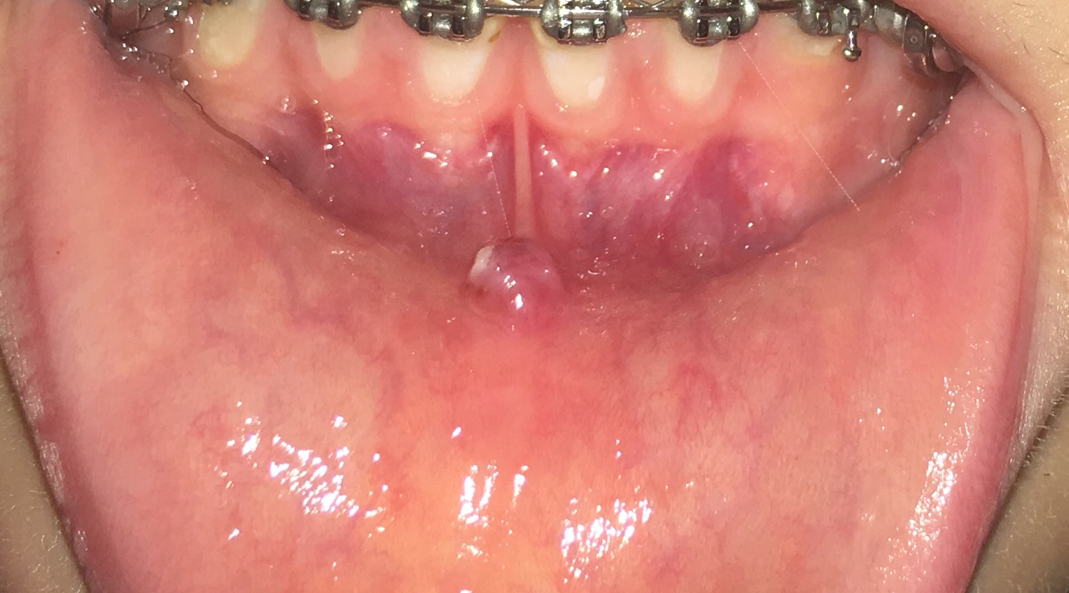 Pickel an meiner inneren Unterlippe? (Zahnspange, Mund, Blase) pickel am mund