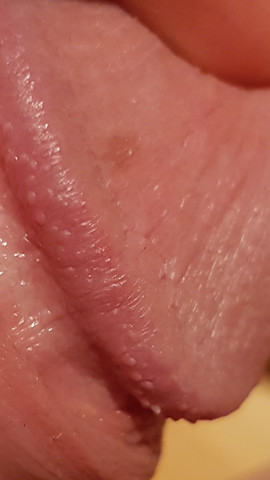 Penis am weiße bläschen Balanitis: Entzündung