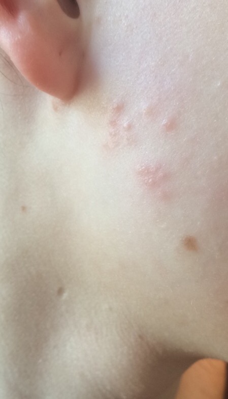 Pickel an Wange? (Gesundheit, Medizin) pickel auf der wange loswerden