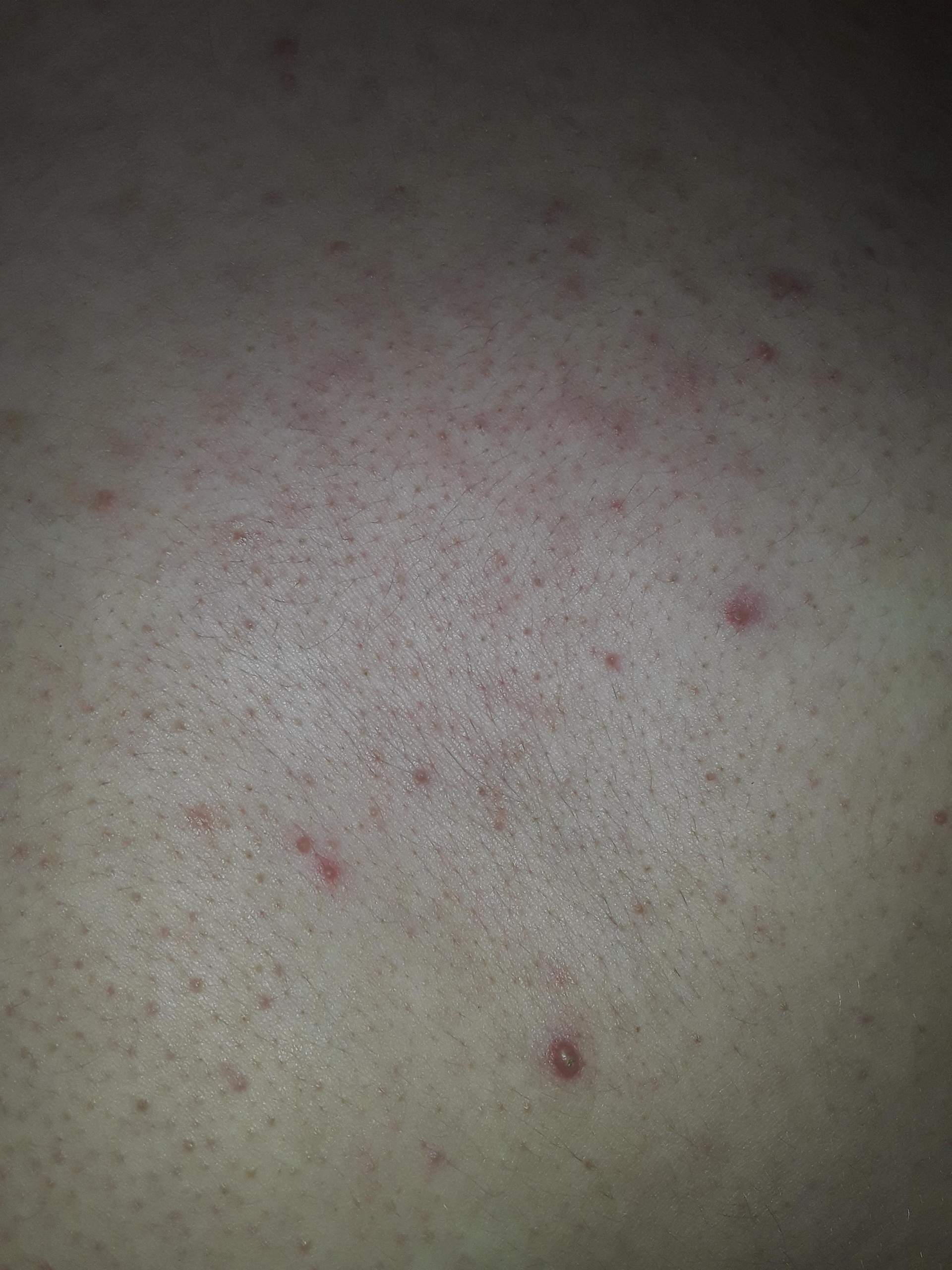 Pickel auf brust? (Gesundheit und Medizin, Haut) pickel brust frau