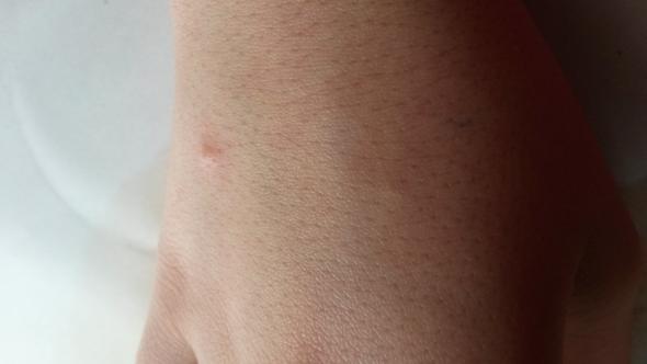 Pickel Auf Dem Handrucken Hand Pickel Auf Dem Handrucken Hand