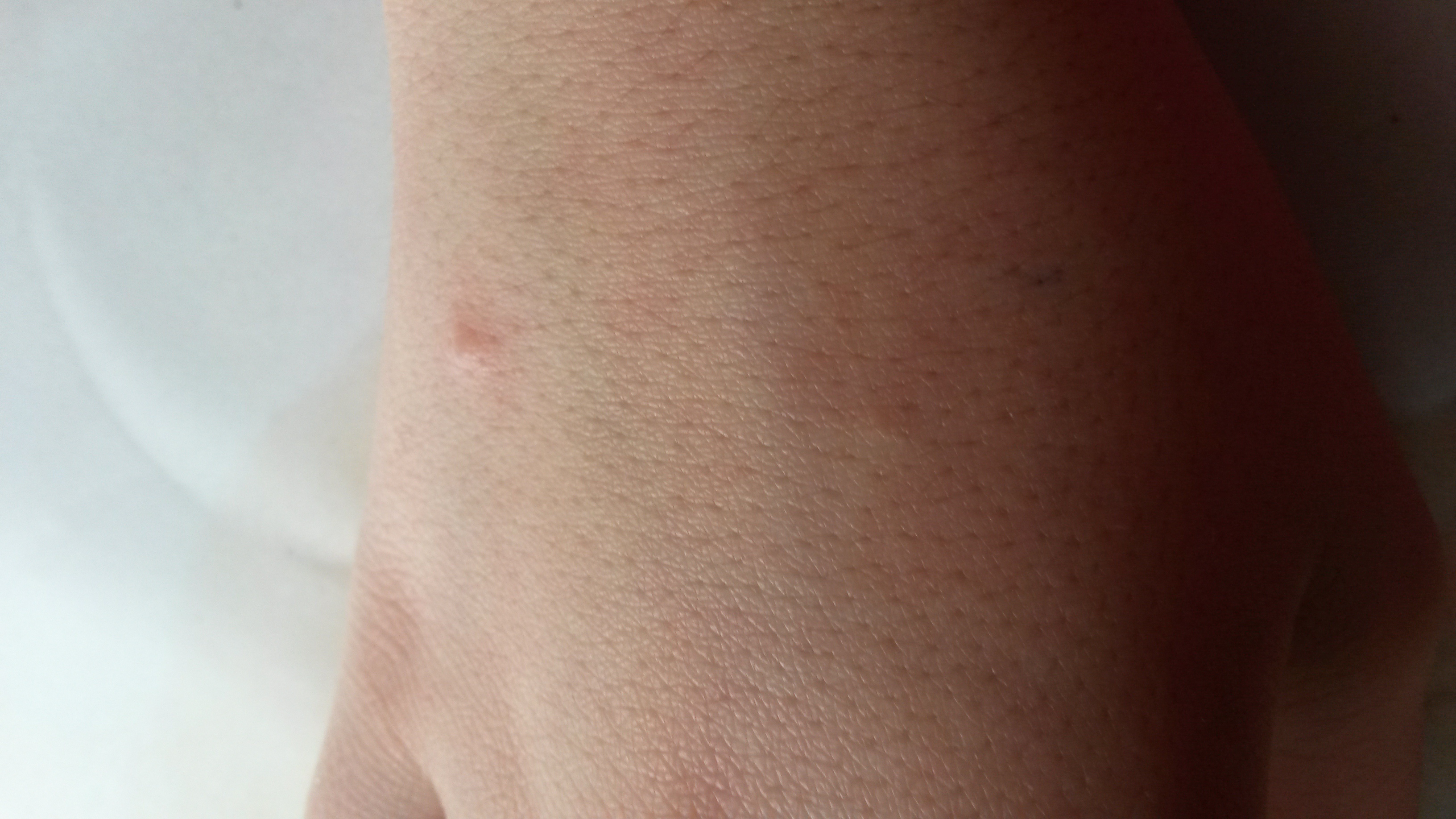 Pickel auf dem Handrücken!? (Hand) pickel an hand