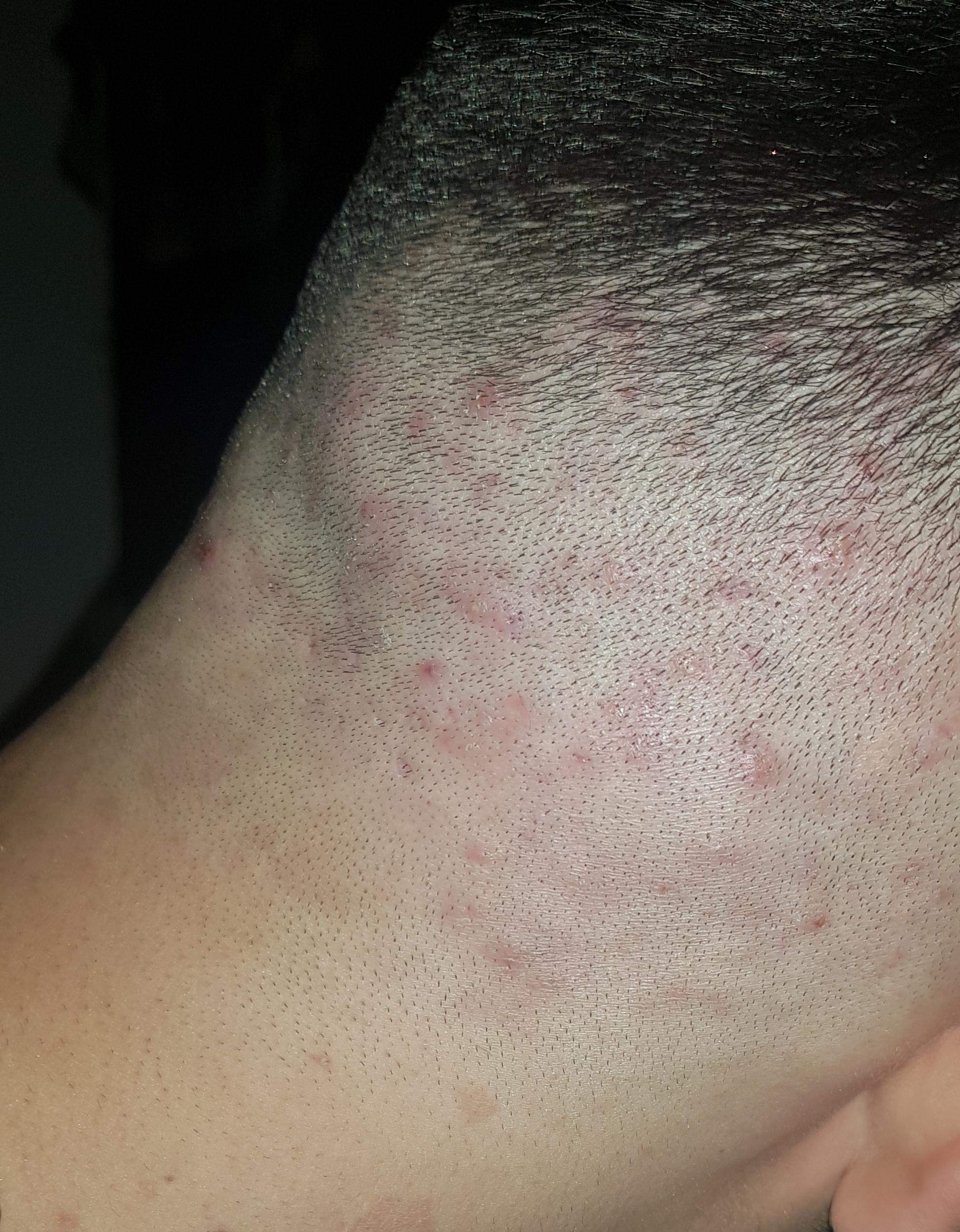 Pickel auf der Kopfhaut? (Gesundheit und Medizin, Akne)