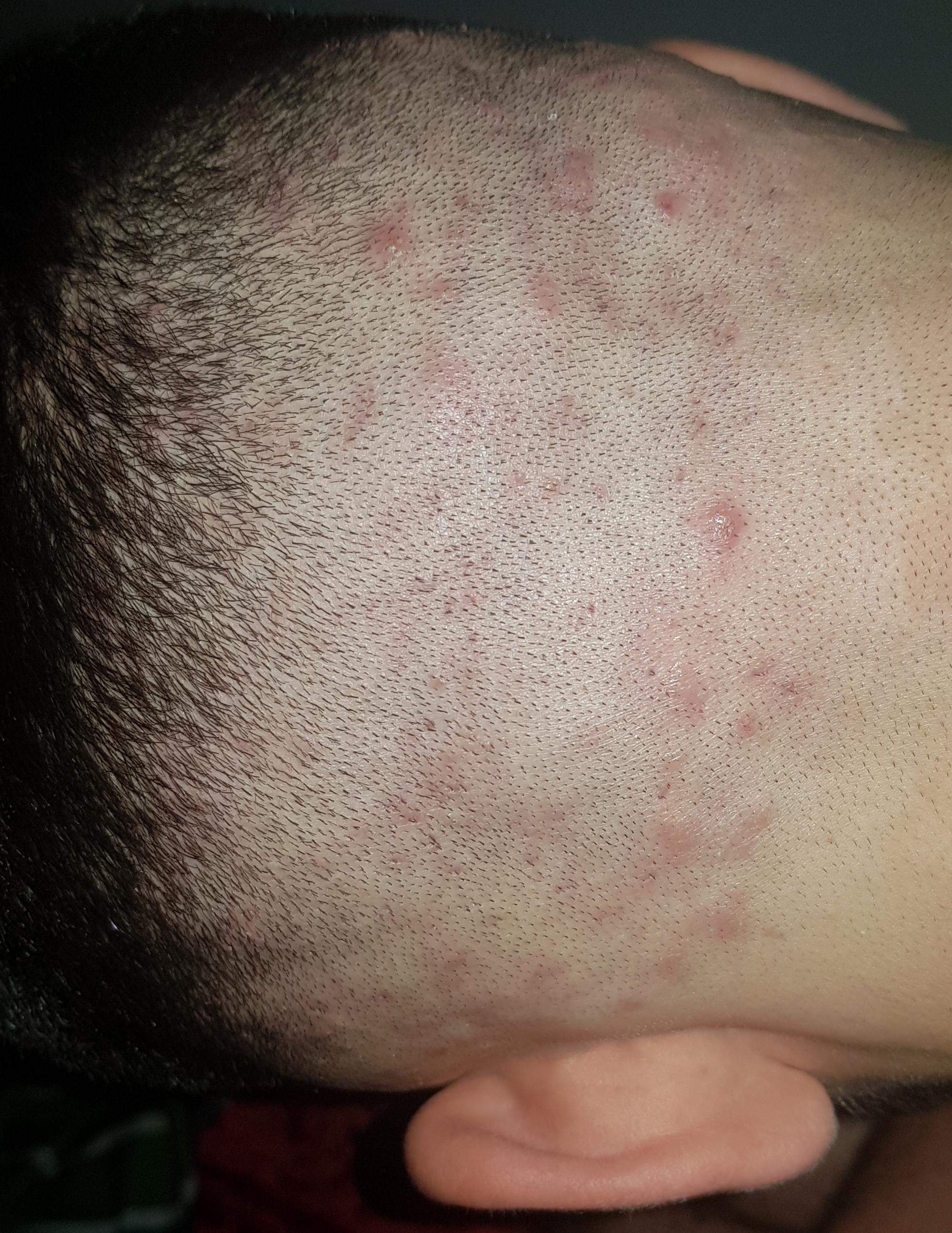 Pickel auf der Kopfhaut? (Gesundheit und Medizin, Akne) pickel auf kopfhaut