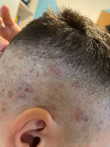 Pickel auf der Kopfhaut? (Gesundheit und Medizin, Haare) pickel auf der kopfhaut