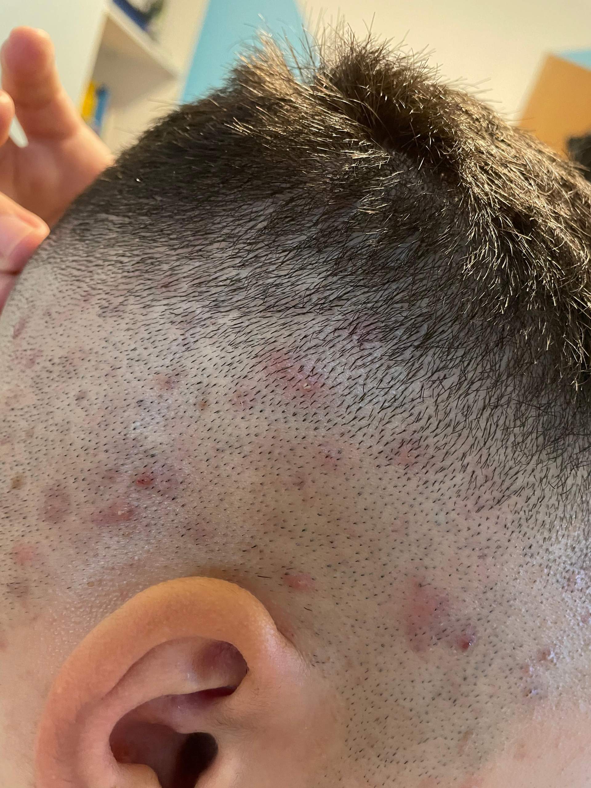 Pickel auf der Kopfhaut? (Gesundheit und Medizin, Haare) pickel auf kopfhaut