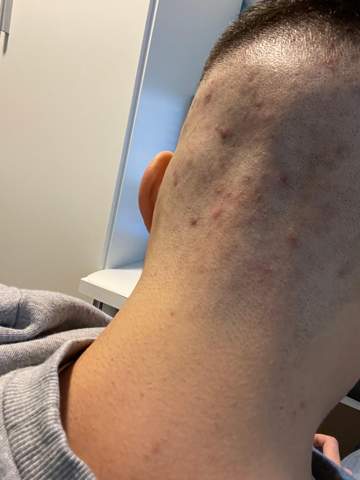 Pickel auf der Kopfhaut? (Gesundheit und Medizin, Haare) pickel auf der kopfhaut