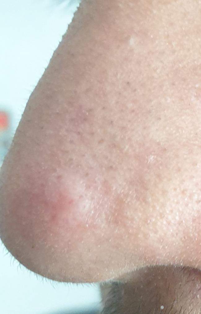 Pickel auf der Nase geht nicht weg (Hilfe)? (Gesundheit und Medizin) pickel auf der nase