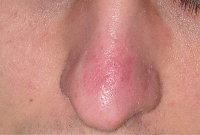 Pickel auf der Nase seit über 2 Monaten? (Haut, Hautarzt, Dermatologie) pickel auf der nase