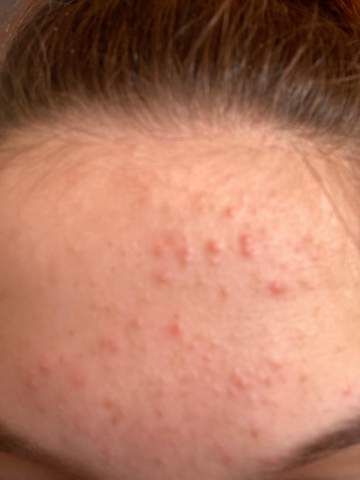 pickel an stirn ursache pickel an stirn ursache