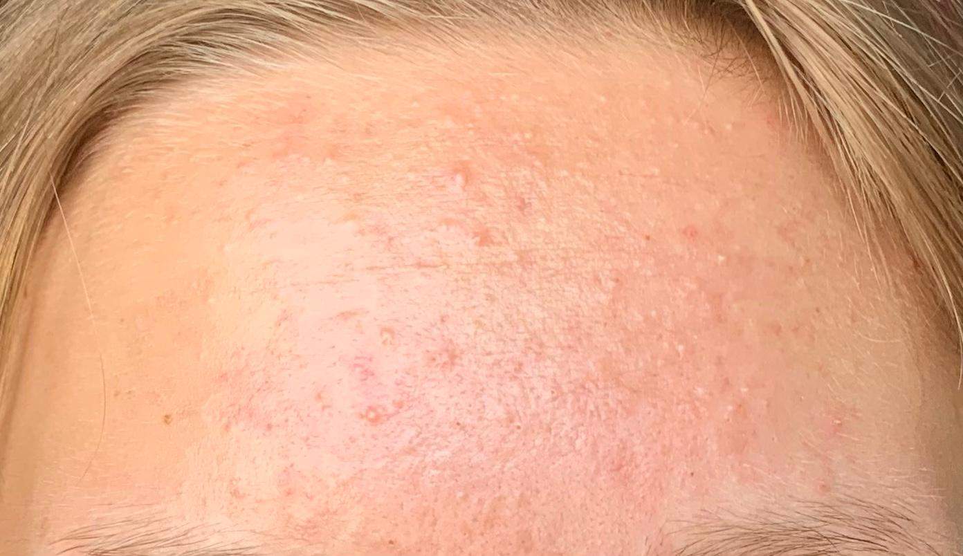 pickel auf der stirn hausmittel pickel auf der stirn hausmittel