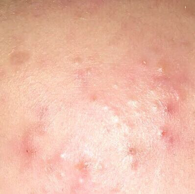 Pickel auf der Stirn wegbekommen? (Gesundheit und Medizin, Gesundheit, Beauty) pickel am stirn