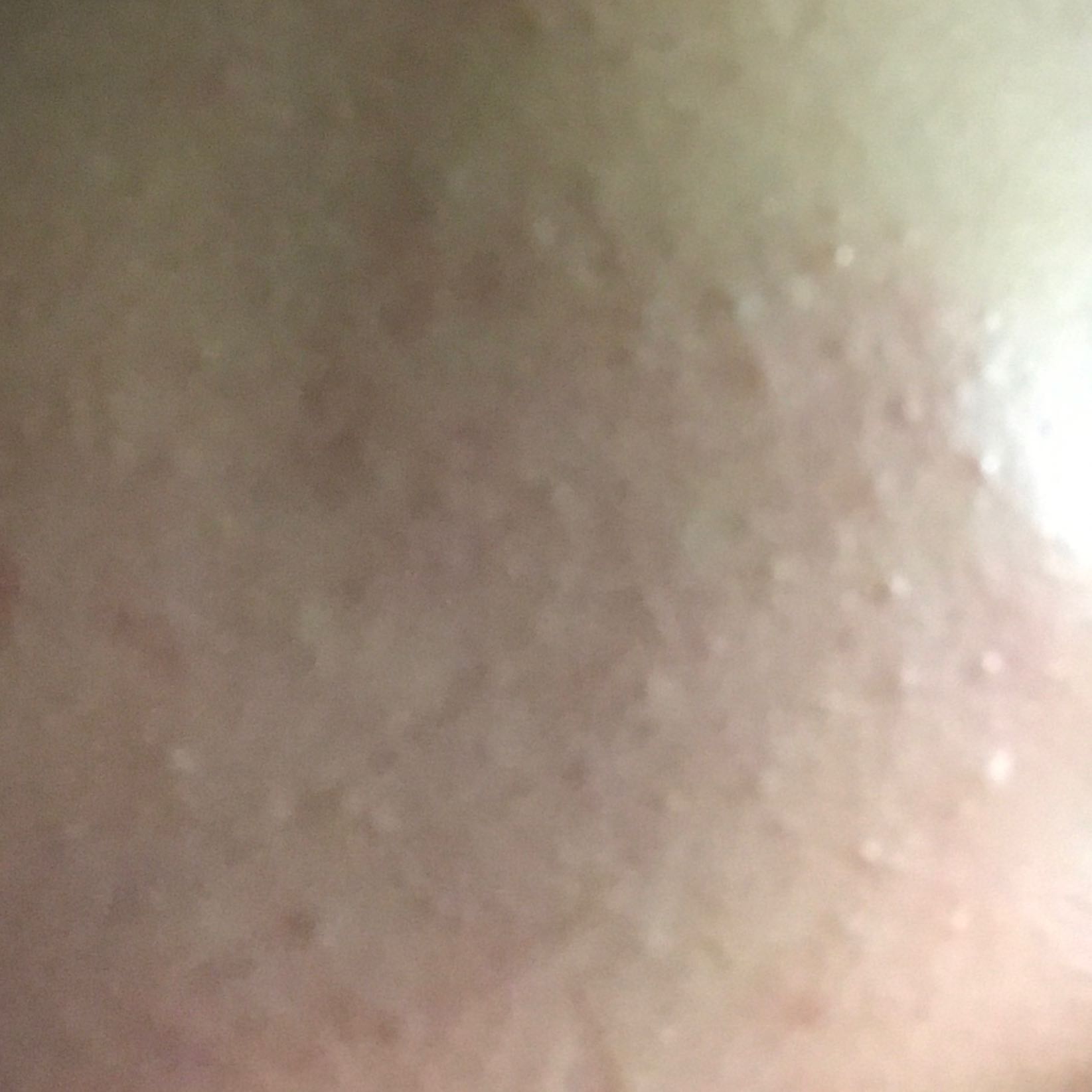 Pickel Auf Der Wange Akne Beauty Torte