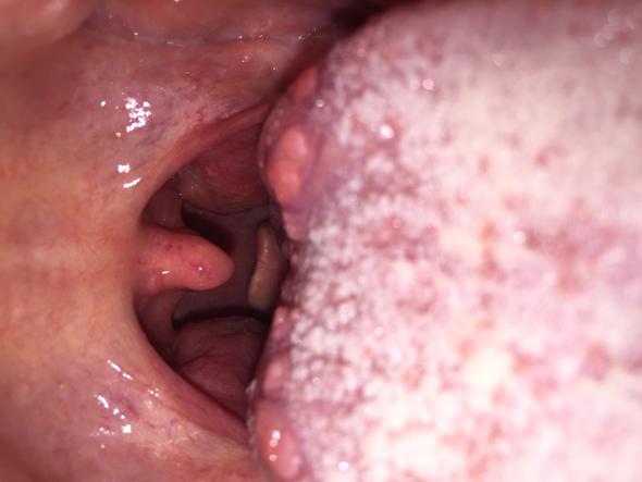 Pickel Auf Der Zunge Kraterformig Normal Oder Nicht Gesundheit Medizin Krankheit Pickel Auf Der Zunge Kraterformig Normal Oder Nicht Gesundheit Medizin Krankheit