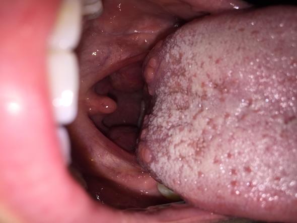 Pickel Auf Der Zunge Kraterformig Normal Oder Nicht Gesundheit Medizin Krankheit Pickel Auf Der Zunge Kraterformig Normal Oder Nicht Gesundheit Medizin Krankheit