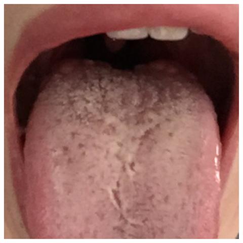 Download Rote Pickel Auf Der Zunge Hinten Images