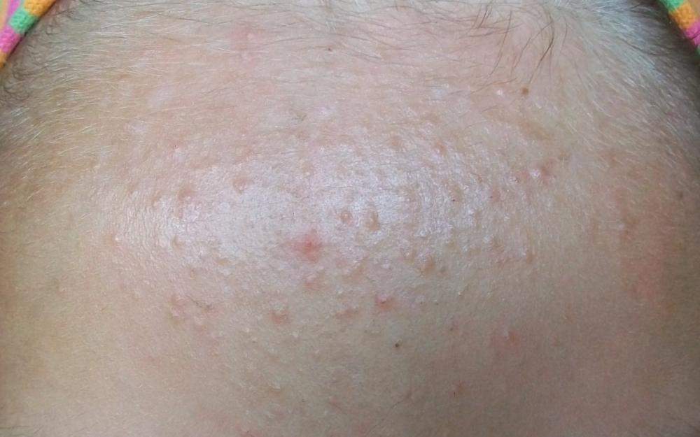 Pickel auf dr Stirn pickel an der stirn ursache