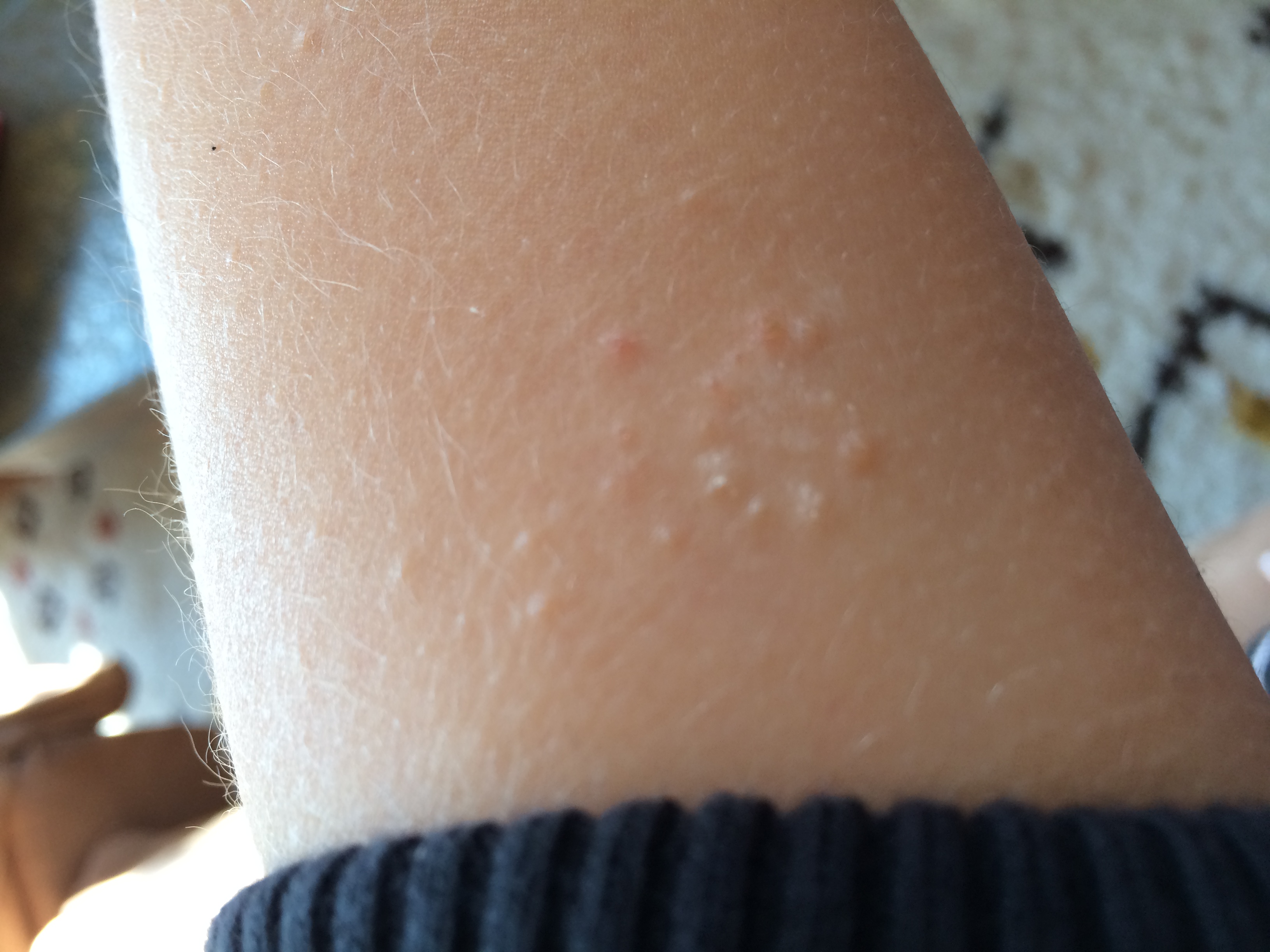 Pickel auf Oberarm? (Gesundheit und Medizin, Allergie, Hautkrankheit)