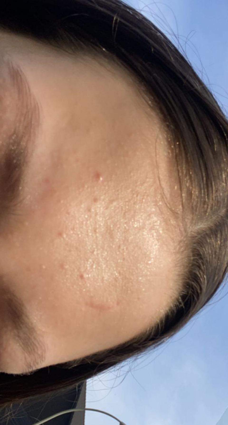 Pickel auf Stirn? (Gesundheit und Medizin, Beauty, Haut) pickel auf stirn