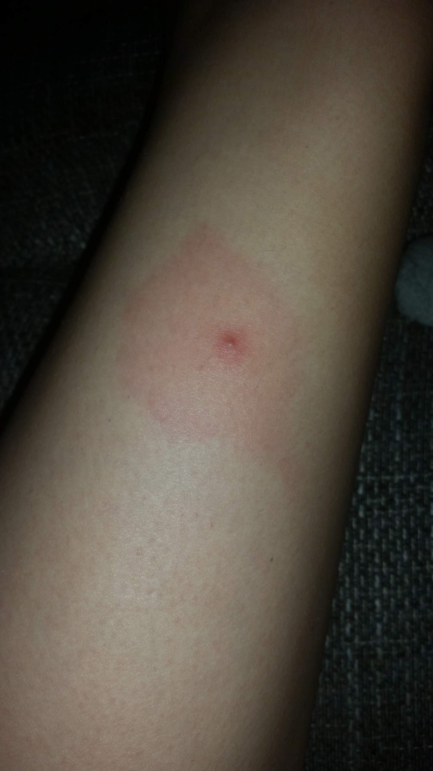 Pickel ausgedrückt und nun grosser roter Kreis angst Blutvergiftung