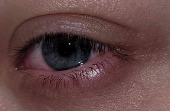 Auge beule im Lipom: Ursachen,