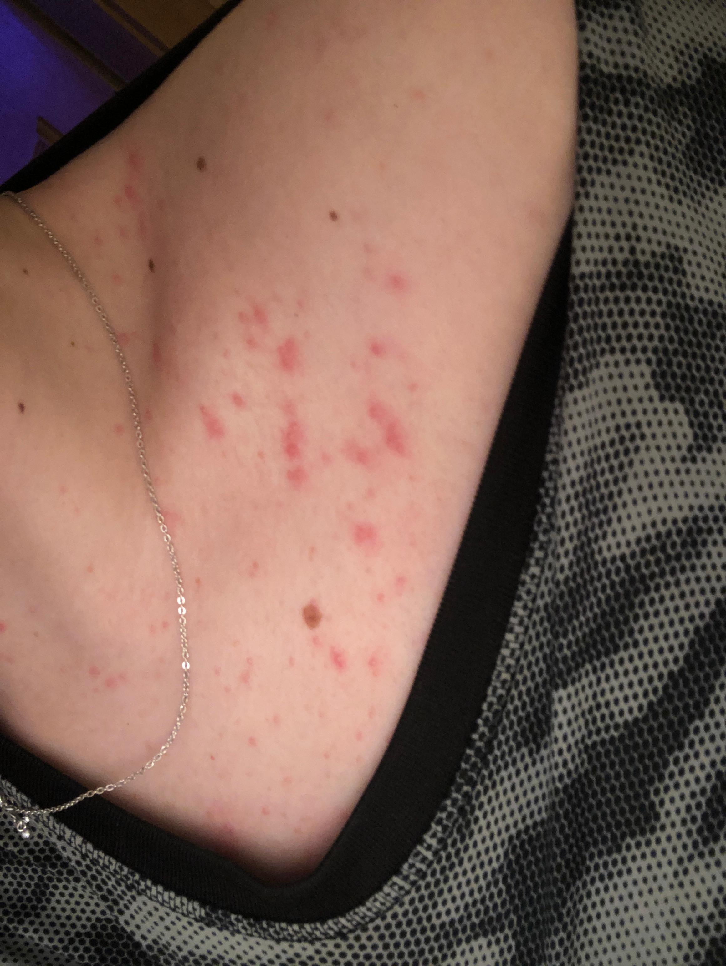 Pickel Dekollete Haut Pickel Dekollete Haut