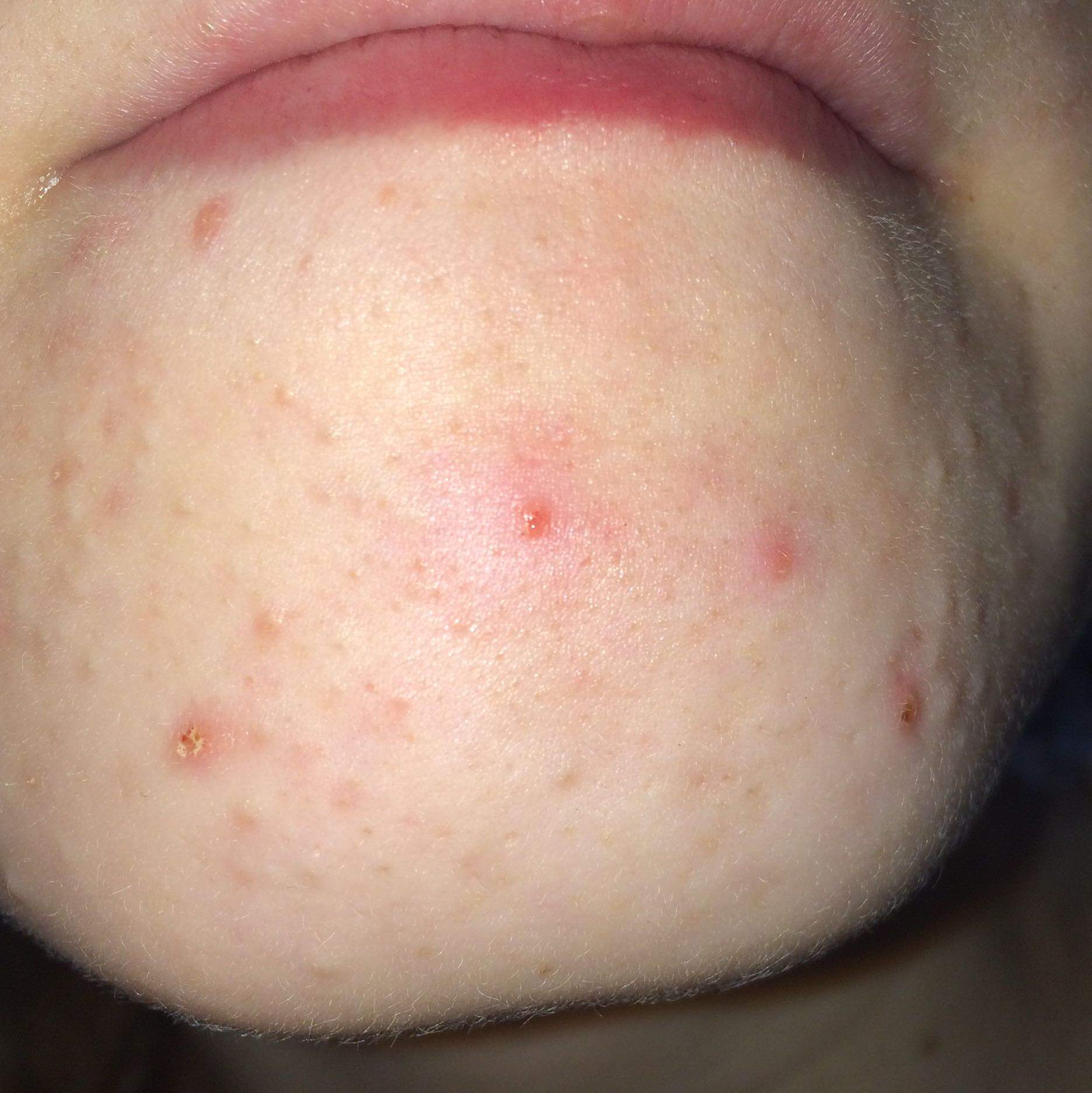 Pickel endlich wegbekommen HILFE!? (Haut, Behandlung)