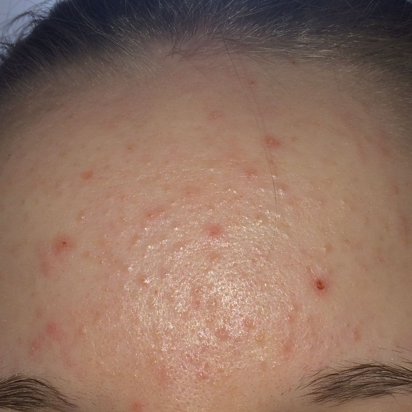 Pickel endlich wegbekommen HILFE!? (Haut, Behandlung)