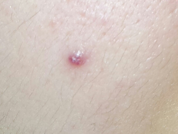 Pickel Unter Der Haut Geht Nicht Weg - ihan tasga pickel hintern