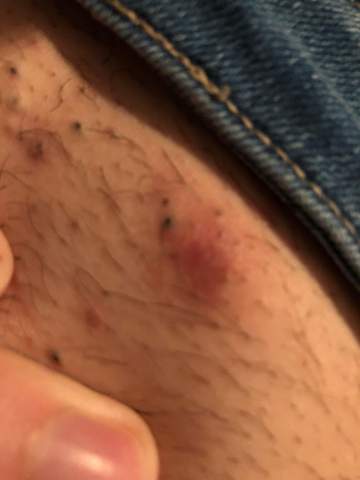 pickel geht seit wochen nicht weg