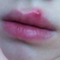 pickel, griebe an der lippe.. was tun? (Herpes)