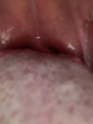 Pickel Hinter Der Zunge Pickel Hinter Der Zunge