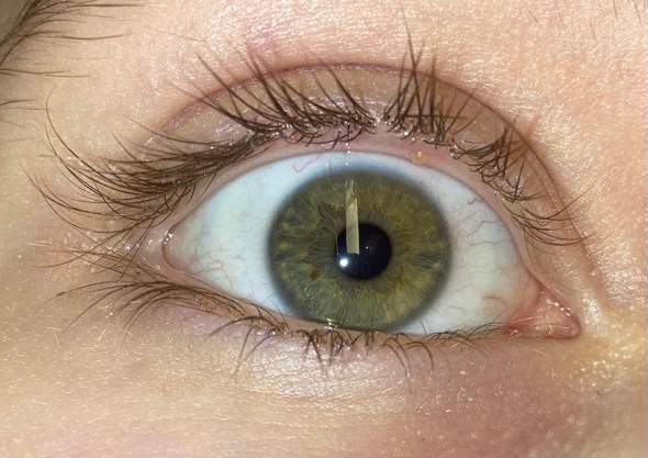 Pickel Im Auge Gesundheit Und Medizin Haut Augen Pickel Im Auge Gesundheit Und Medizin Haut Augen