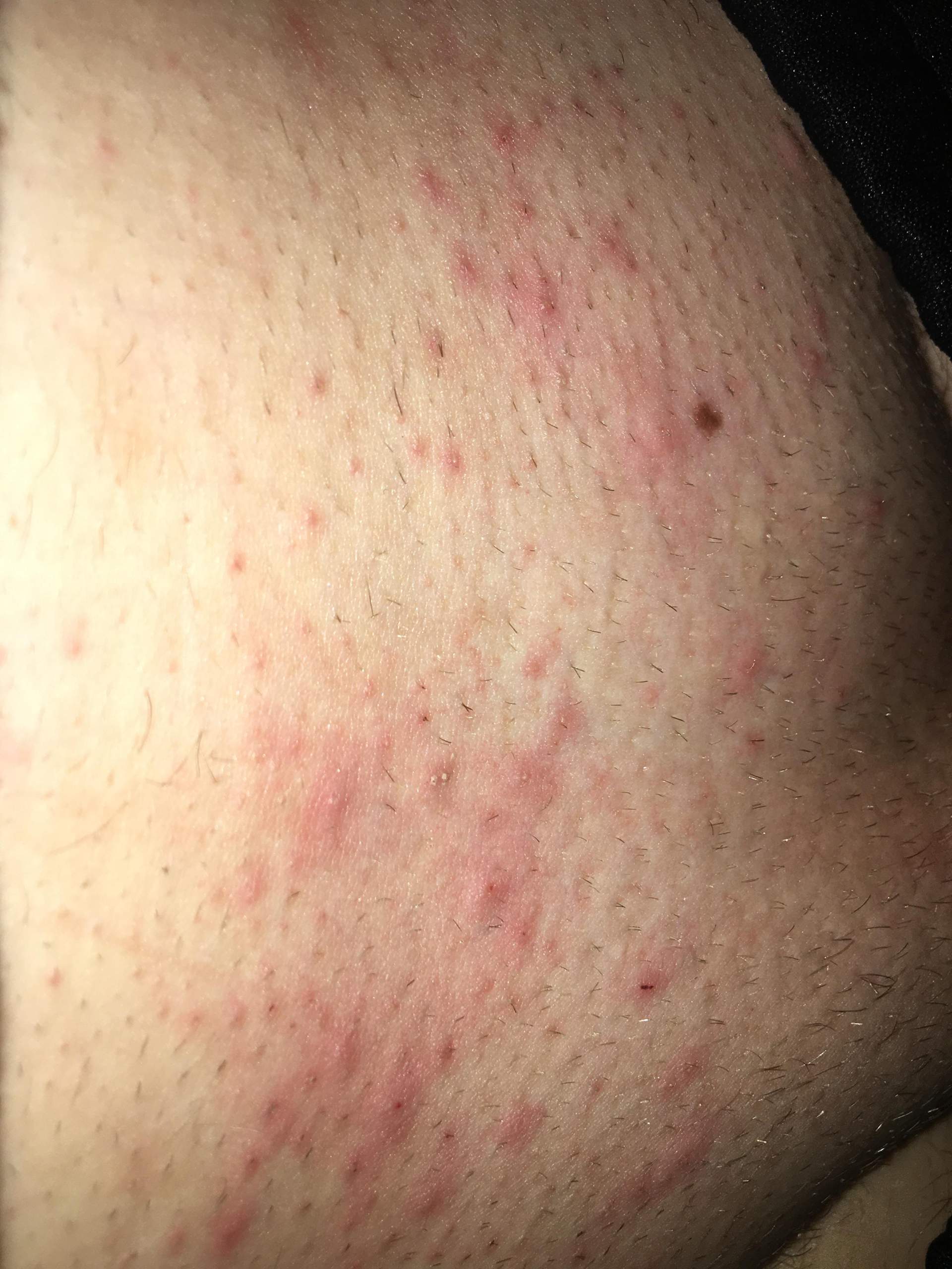 Pickel im Intimbereich nach Rasur? Pickel im Intimbereich nach Rasur?