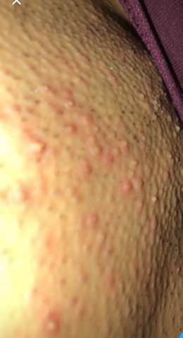 Pickel Im Intimbereich Normal Oder Nicht Gesundheit Und Medizin Madchen Korper Pickel Im Intimbereich Normal Oder Nicht Gesundheit Und Medizin Madchen Korper